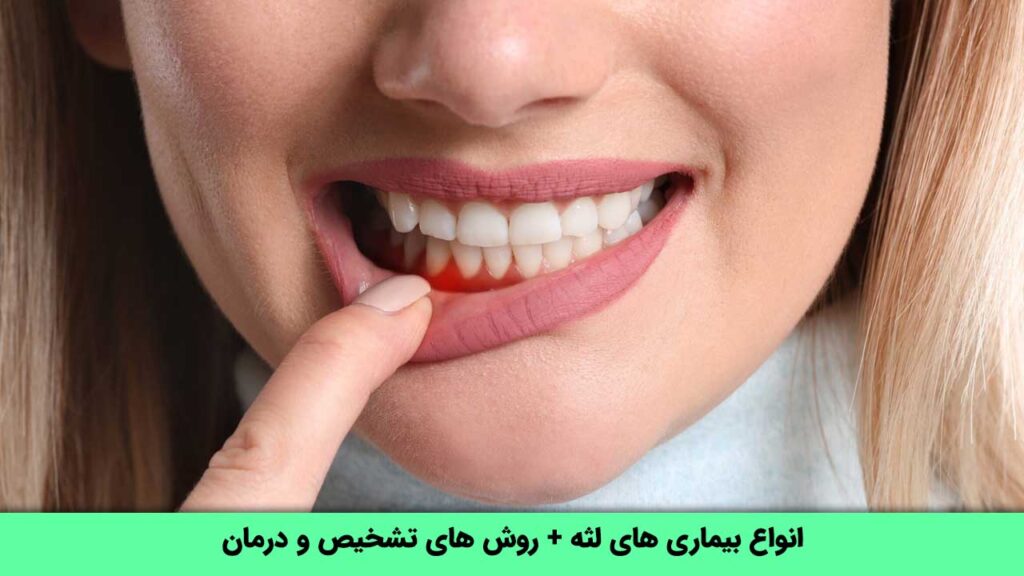 بیماری های لثه