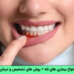 بیماری های لثه