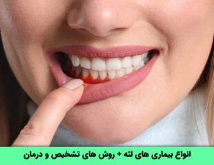 بیماری های لثه