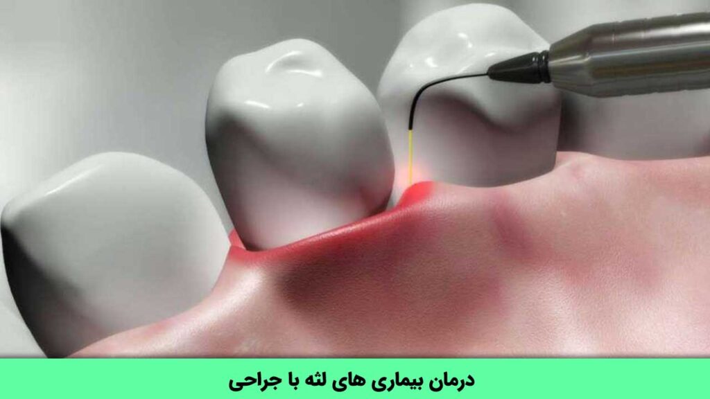 درمان بیماری های لثه با جراحی