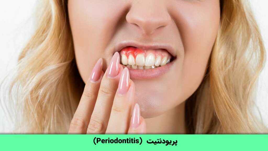 بیماری  پریودنتیت  (Periodontitis) چیست؟