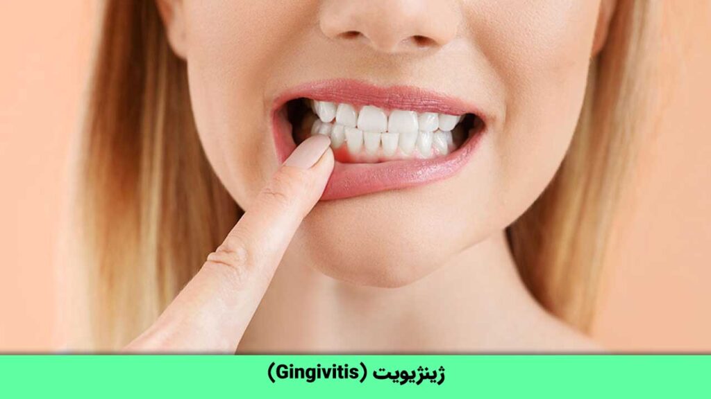 بیماری ژینژیویت (Gingivitis) چیست؟