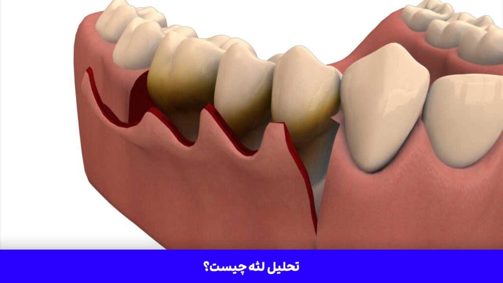 تحلیل لثه چیست؟