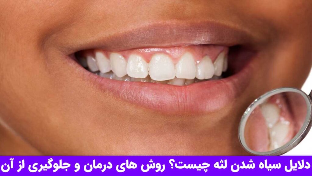 سیاه شدن لثه