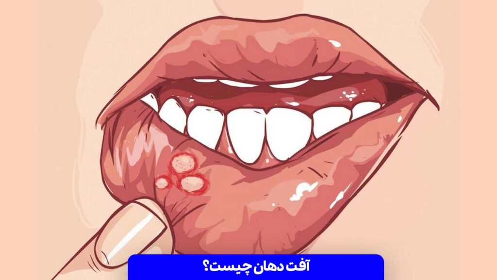 آفت دهان چیست؟