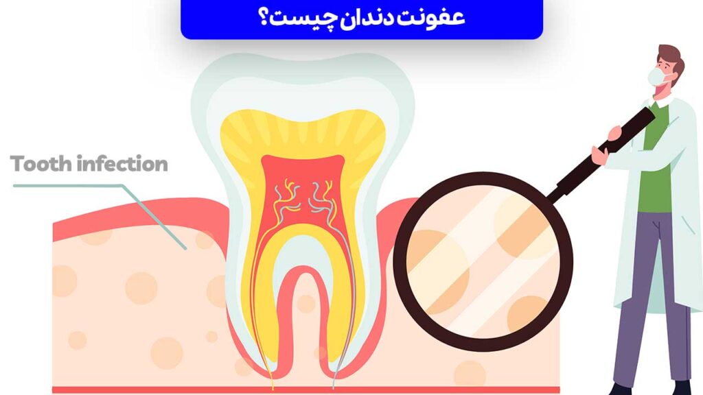 عفونت دندان چیست؟