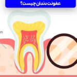 عفونت دندان چیست؟