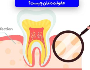 عفونت دندان چیست؟